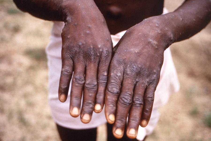An image created during an investigation into an outbreak of monkeypox, which took place in the Democratic Republic of the Congo (DRC), 1996 to 1997, shows the hands of a patient with a rash due to monkeypox, in this undated image obtained by Reuters on May 18, 2022. CDC/Brian W.J. Mahy/Handout via REUTERS