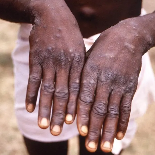 Massachusetts identifies first U.S. case of monkeypox infection