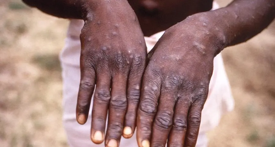 Massachusetts identifies first U.S. case of monkeypox infection