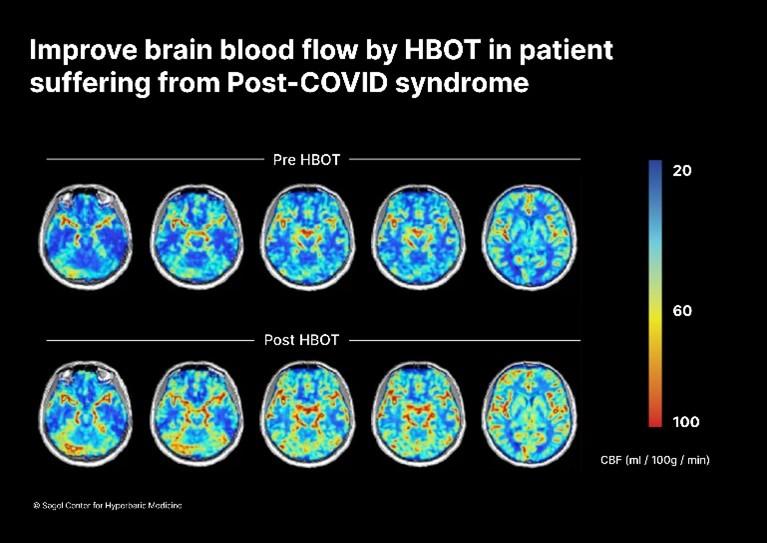 Figure 4 – Improved cerebral blood flow by HBOT in patient suffering from post-COVID symptoms
