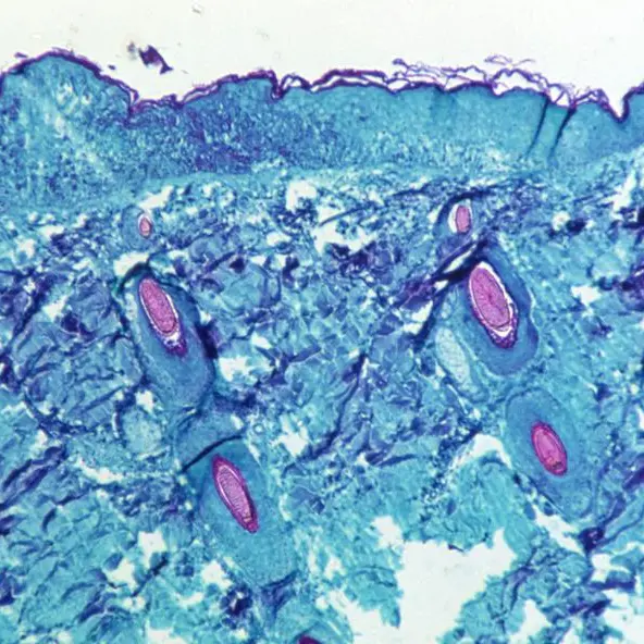 What vaccines, treatments do we have to combat monkeypox?