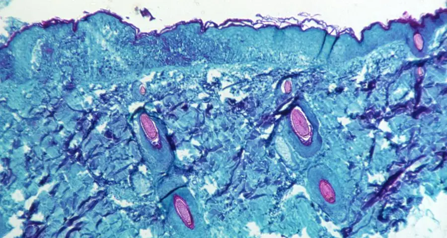 What vaccines, treatments do we have to combat monkeypox?