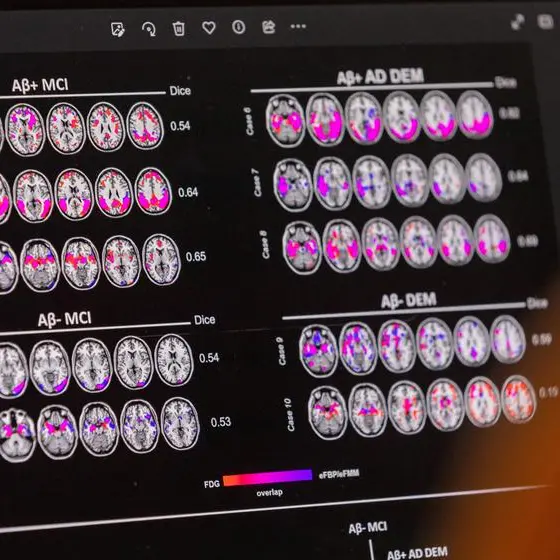 Biogen to cut 1,000 jobs to save costs as Alzheimer's drug launch gathers pace