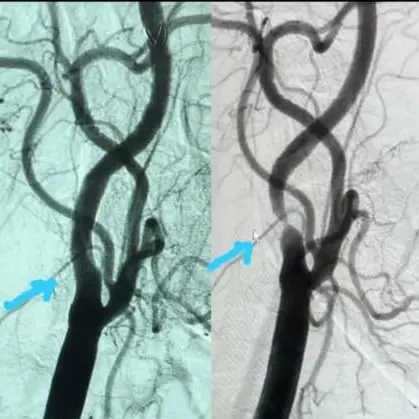 Interventional Cardiologist successfully performs a rare carotid stent