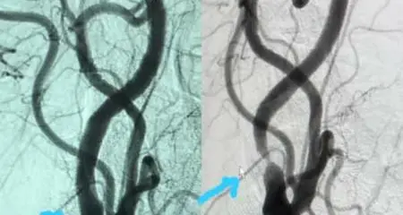 Interventional Cardiologist successfully performs a rare carotid stent