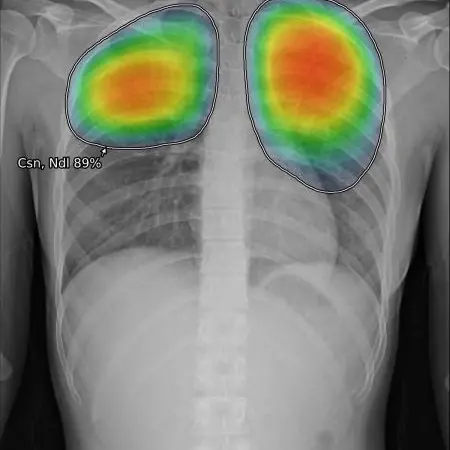 GE Healthcare launches new AI Suite to detect chest X-ray abnormalities, including pneumonia caused by COVID-19 & tuberculosis