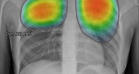 GE Healthcare launches new AI Suite to detect chest X-ray abnormalities, including pneumonia caused by COVID-19 & tuberculosis