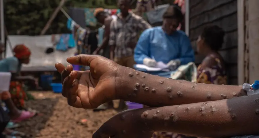 Mpox outbreak: DR Congo lacks vaccines to curb infections