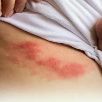 New awareness campaigns on shingles launched in alignment with World Immunization Week