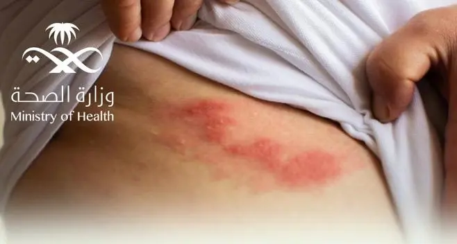 New awareness campaigns on shingles launched in alignment with World Immunization Week
