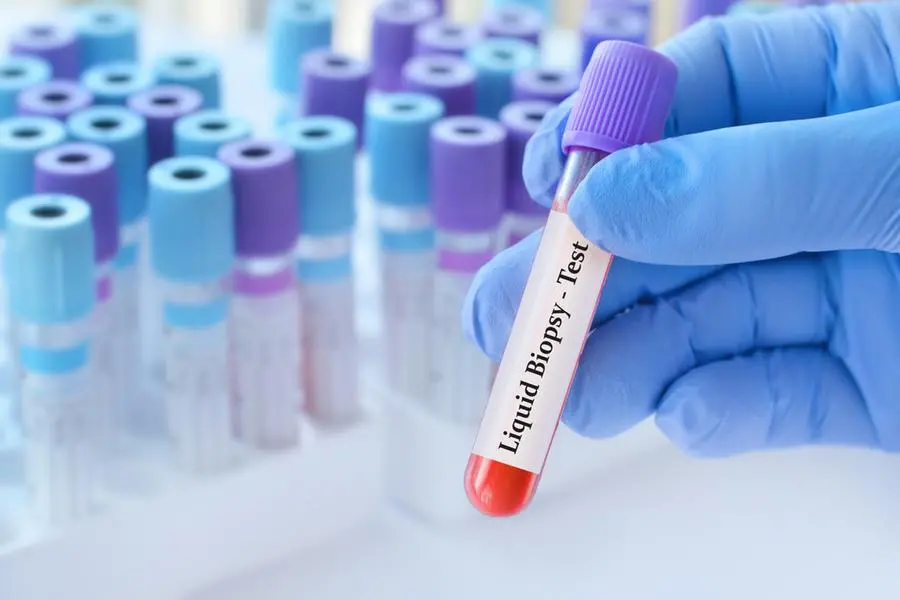 Doctor holding a test blood sample tube with Liquid Biopsy test on the background of medical test tubes with analyzes. Image used for illustrative purpose. Image courtesy: Getty Images/ SyhinStas , Getty Images