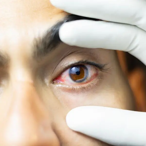 Abu Dhabi Biobank, Bascom Palmer Eye Institute partner to establish Middle East's first Eye Bank in Abu Dhabi