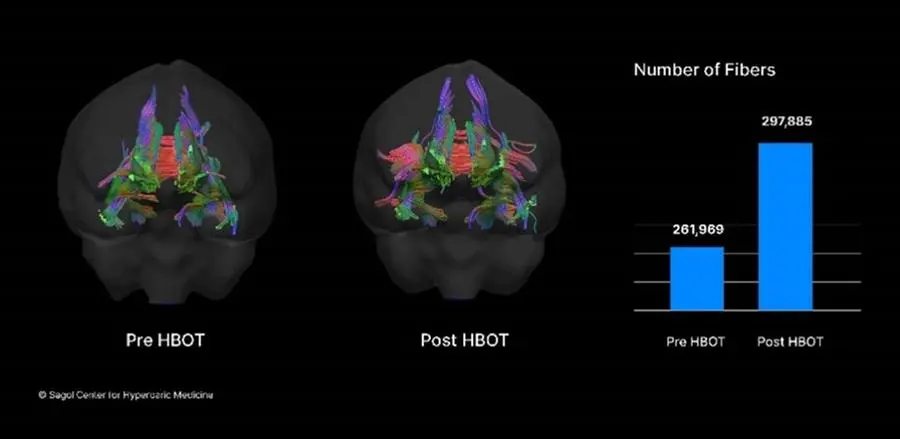 Figure-3 – Generation of new nerve fibers (neurogenesis) in the frontal brain regions of patient with Long-COVID, Pre and Post HBOT. Regions responsible for attention, mental state and executive functions (capacity to plan, organize, initiate, self-monitor and control one's responses in order to achieve a goal).