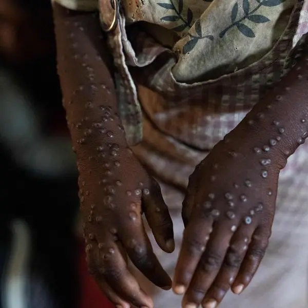 Philippines: Mask mandate, lockdowns not needed to control mpox