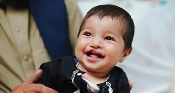 Smile Train reinforces commitment to sponsor more cleft surgeries after supporting more than 640,000 in MENA region