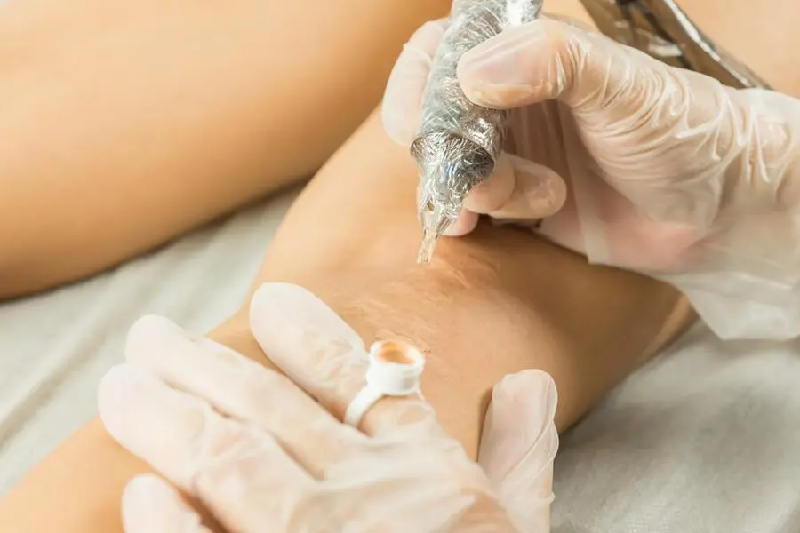 Scar camouflage therapy with rotative machine. Getty Images Image used for illustrative purpose. , Getty Images